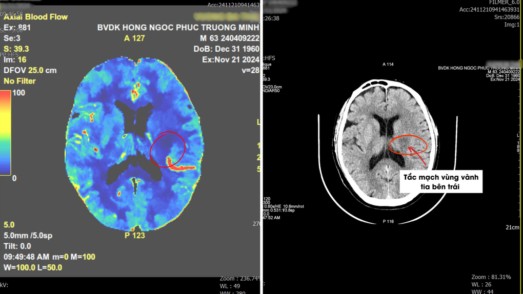Phát hiện đột quỵ sớm nhờ chụp CT 2.560 lát cắt, bệnh nhân thoát liệt người - 1