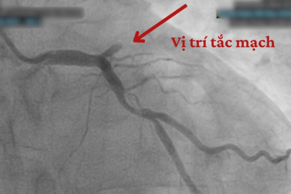 Vì sao biến cố tim mạch gia tăng vào mùa lạnh? - 1